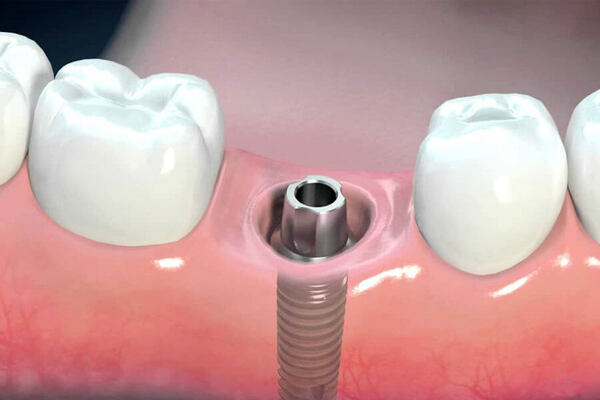Nha khoa Emedic Dental thực hiện cấy ghép Implant chuẩn quy trình của Bộ Y Tế