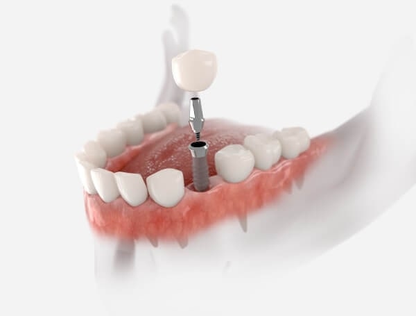 Abutment Implant là một phần không thể thiếu trong lĩnh vực nha khoa và cấy ghép Implant