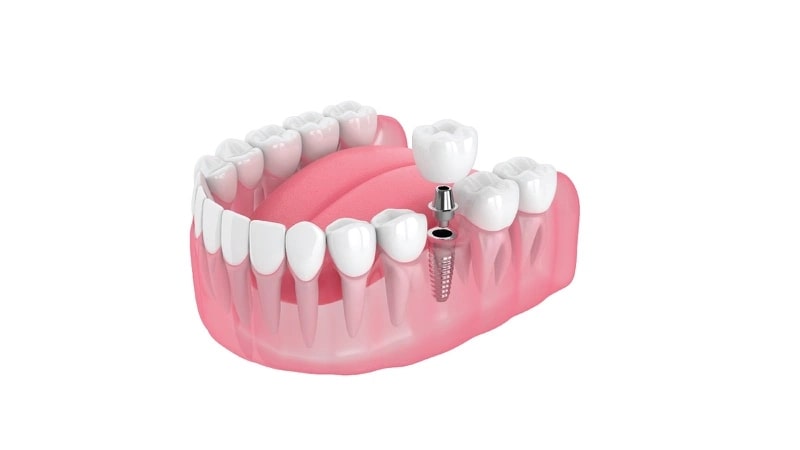 Khi lựa chọn Abutment trong cấy ghép Implant, bạn cần xem xét một số lưu ý