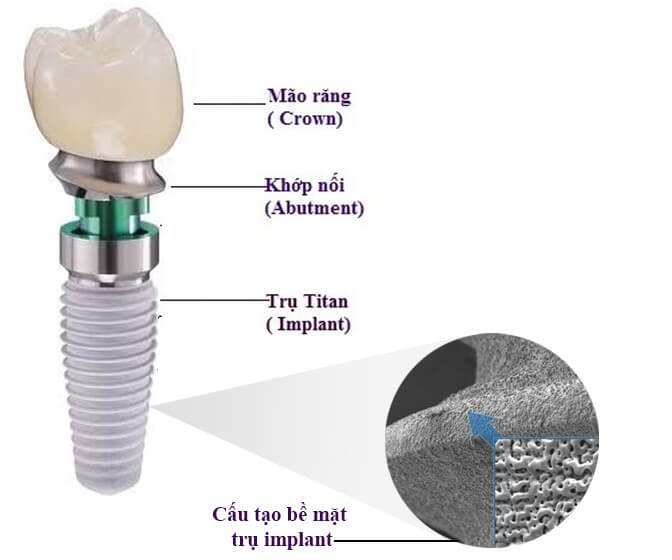 Cấu tạo của Abutment Implant