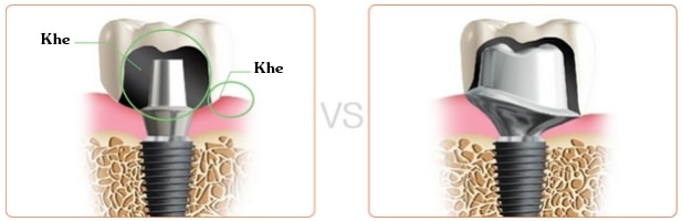 So sánh Abutment có sẵn và Abutment tùy chỉnh