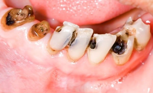 Răng sâu nặng là thế nào?