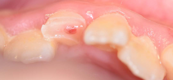 Tình trạng răng bị gãy vỡ hoặc mẻ