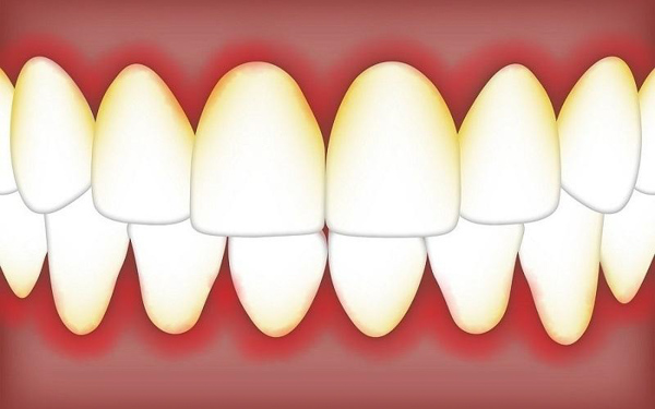 Nha chu là bệnh răng cần điều trị sớm