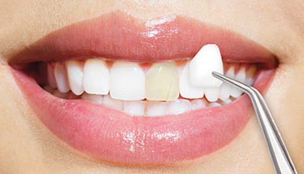 Nhiều người thắc mắc việc bọc răng sứ 1 chiếc có được không?