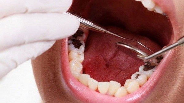 Các bước bọc sứ cho răng sâu chính xác nhất