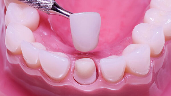 Nha khoa Emedic Dental sẽ giúp bạn làm răng sứ an toàn và không lo hôi miệng