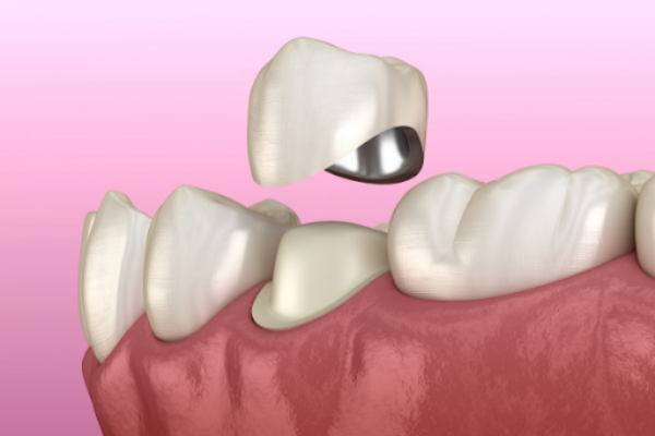 Có rất nhiều nguyên nhân khác nhau dẫn đến tình trạng đau khi làm răng sứ