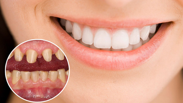 Chi phí bọc răng sứ cho răng hô phụ thuộc yếu tố nào?