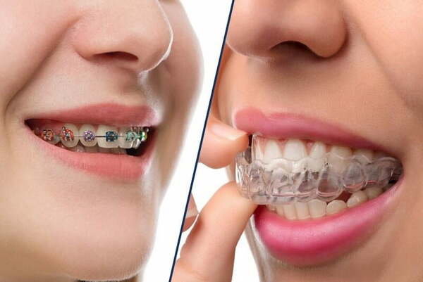 Bạn cần chú ý đến nhiều vấn đề khác nhau khi niềng răng bọc sứ