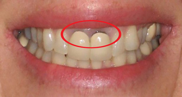 Tình trạng Viền nướu của răng sứ bị đen