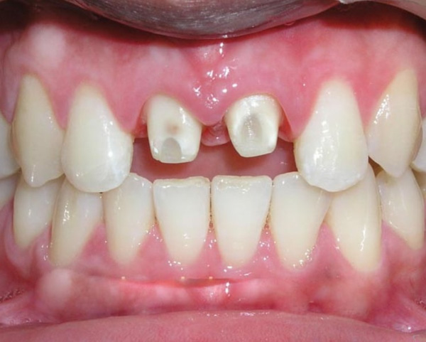 Khi nào nên bọc răng sứ cho 2 răng cửa?