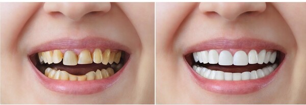 Nếu như bạn sở hữu hàm răng ố vàng thì bạn có thể bọc răng sứ để cải thiện