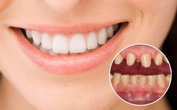 Bạn sẽ sở hữu hàm răng đẹp sau khi bọc răng sứ