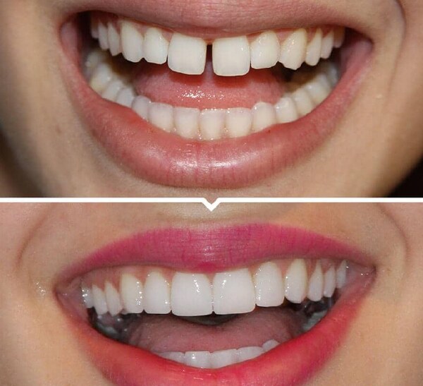Khách hàng của Emedic Dental trước và sau khi bọc răng sứ