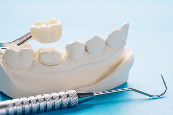 Có nhiều yếu tố khác nhau ảnh hưởng đến chi phí làm răng sứ vĩnh viễn