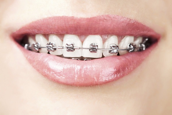 Niềng răng mang lại nhiều lợi ích về cả thẩm mỹ lẫn sức khỏe răng miệng