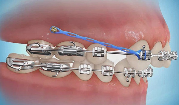 Quy trình thực hiện việc gắn vít trong quá trình niềng răng nhanh chóng