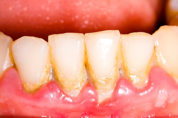 Vôi răng là mảng bám màu trắng hoặc vàng nâu nằm trên thân răng và nướu răng