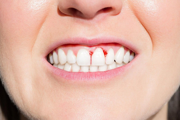 Cạo cao răng có thể tổn thương nướu và chảy máu nếu nha sĩ không thực hiện đúng cách