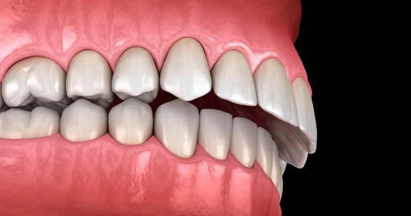 Răng hô nhẹ có thể gây ảnh hưởng đến thẩm mỹ