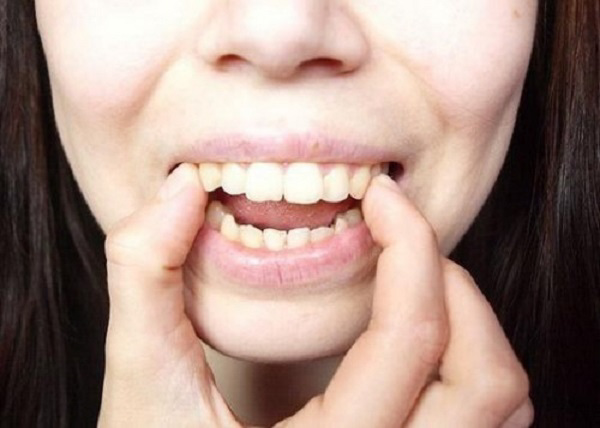 Phương pháp chỉnh răng hô bằng cách dùng tay đẩy răng