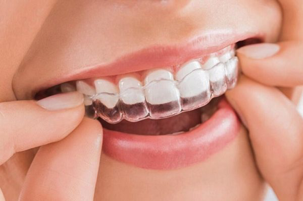 Niềng răng trong suốt giúp giảm hô hiệu quả