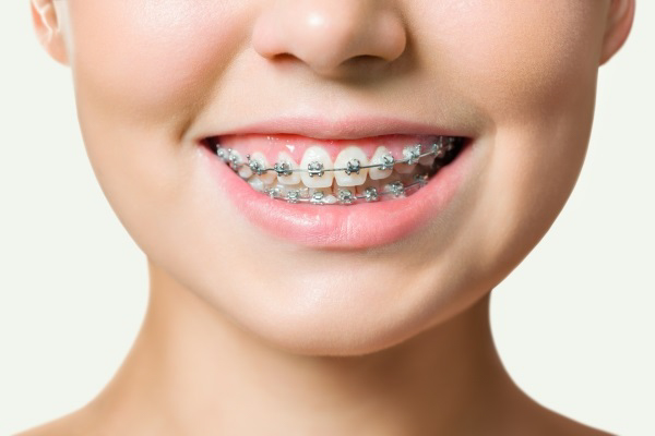 Niềng răng có lợi cho sức khỏe răng miệng của bạn