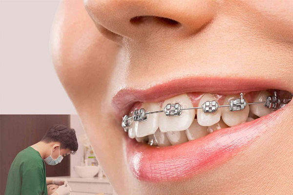 Tùy tình trạng răng, các bạn nên cân nhắc niềng răng