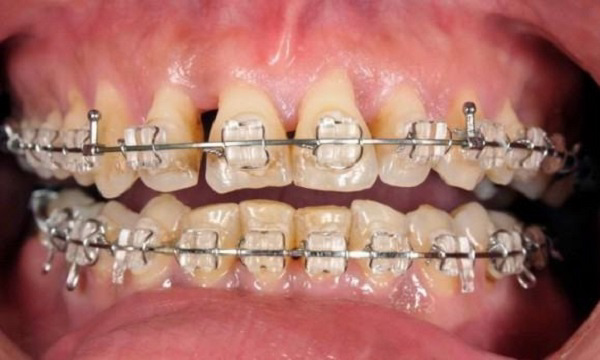 Niềng răng sai kỹ thuật có thể dẫn đến những hậu quả nghiêm trọng
