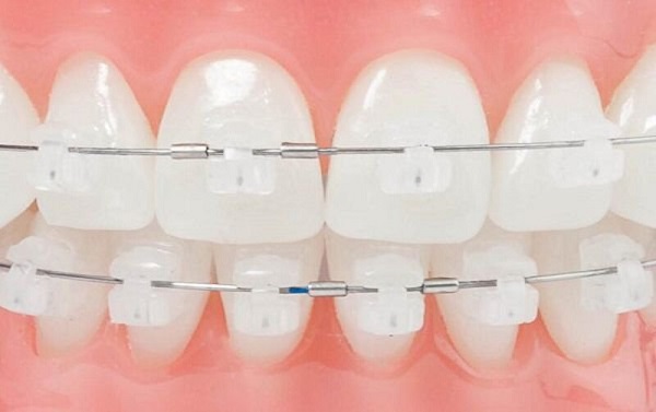 Dây cung niềng răng là một phần quan trọng không thể thiếu trong bộ niềng răng