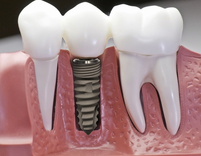 Khi quyết định trồng răng implant, việc lựa chọn địa chỉ uy tín và tốt nhất là rất quan trọng