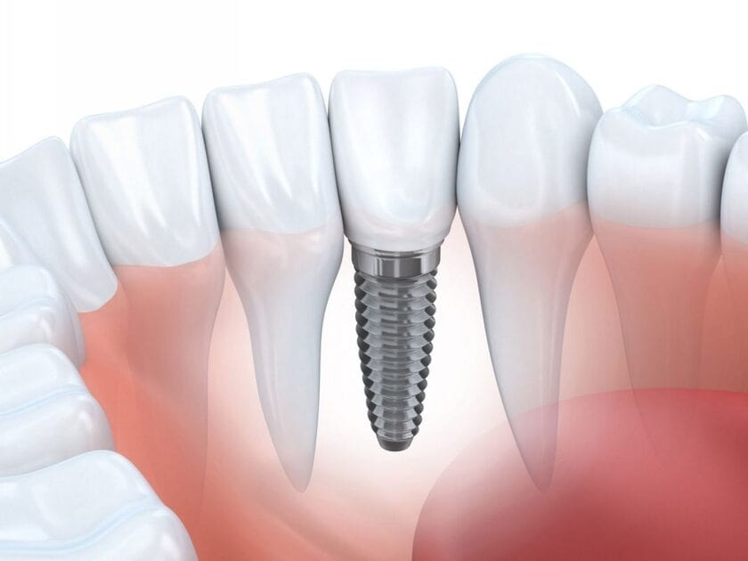 Trồng răng implant là một phương pháp nha khoa tiên tiến để thay thế răng bị mất