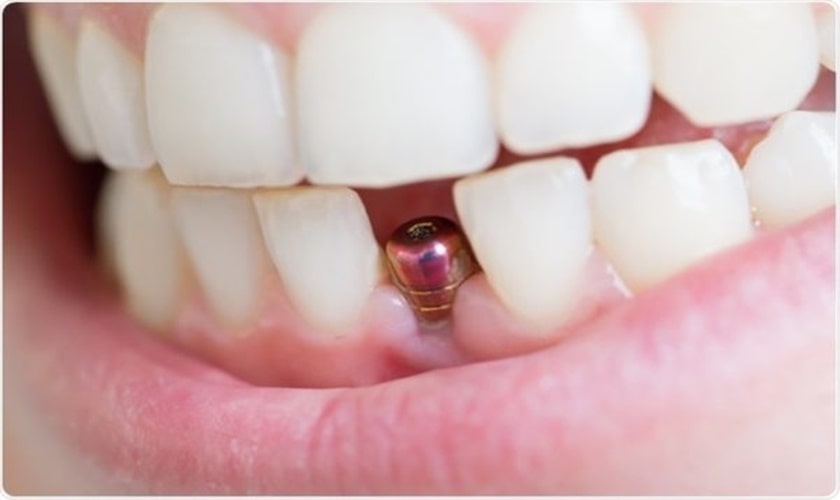 Trong hầu hết các trường hợp, quá trình trồng răng implant không gây đau đớn đáng kể
