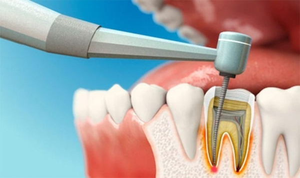 Tìm hiểu về điều trị tủy răng là gì?
