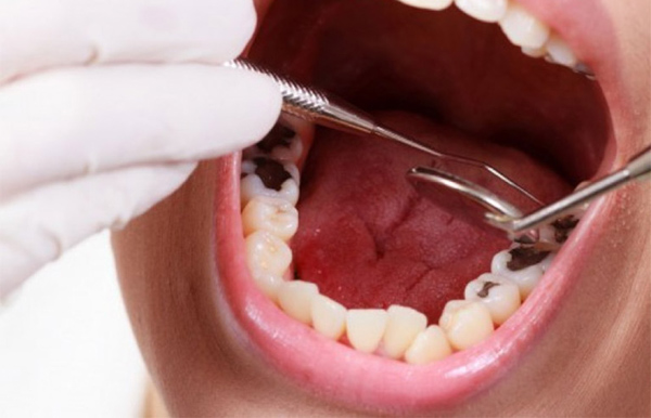 Răng khôn (răng số 8) bị viêm tủy do đâu