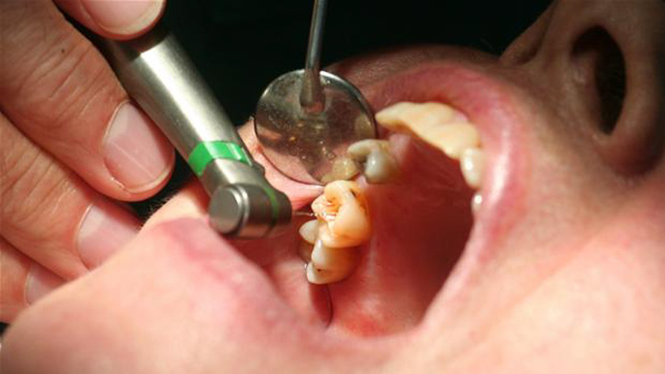 Có nên nhổ răng bị chết tủy không?