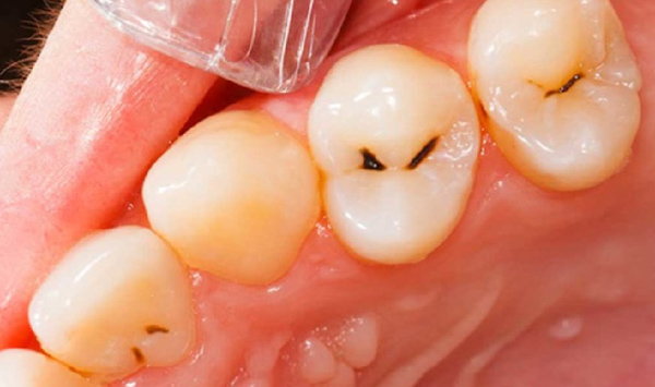 Những triệu chứng của viêm tủy răng mà bạn cần biết