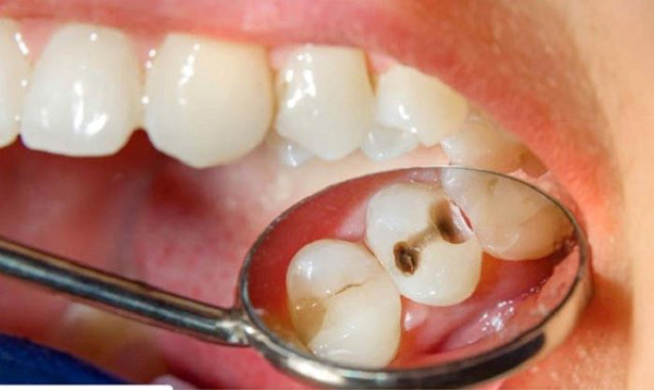 Tình trạng răng bị sâu