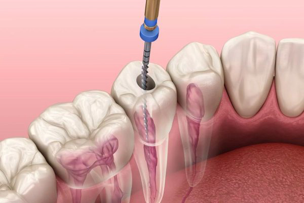 Điều trị tủy răng mất bao lâu?