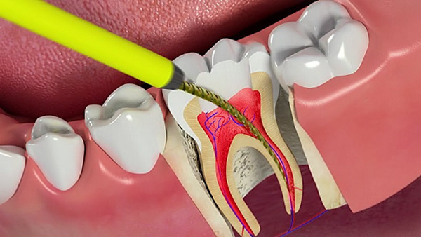 Điều trị tủy răng có nguy hiểm không?