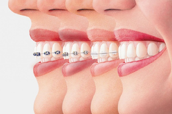 Các giai đoạn trong quá trình niềng răng