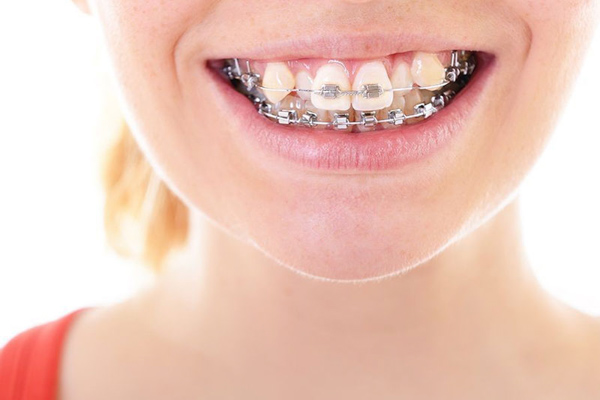 Áp dụng các biện pháp phù hợp để tăng tính thẩm mỹ khi niềng răng