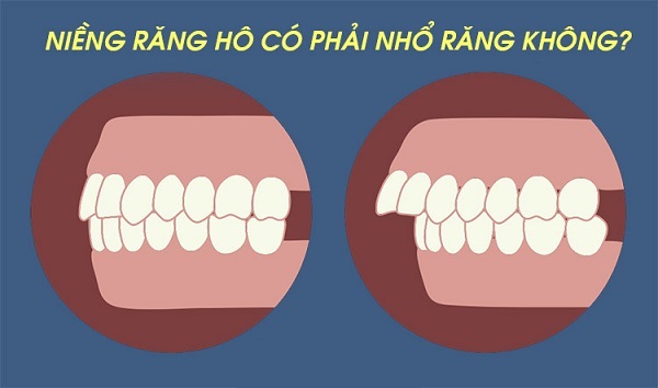 Tùy tình trạng khi niềng răng hô có thể phải nhổ răng hoặc không