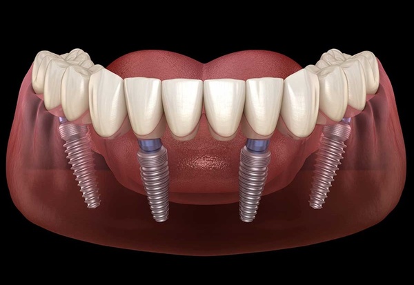 Trồng răng Implant All On 4 là giải pháp phù hợp nhất cho tình trạng mất răng toàn hàm