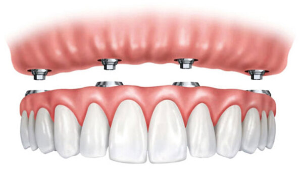 Bác sĩ sẽ sử dụng răng tạm trong quá trình chế tác răng vĩnh viễn