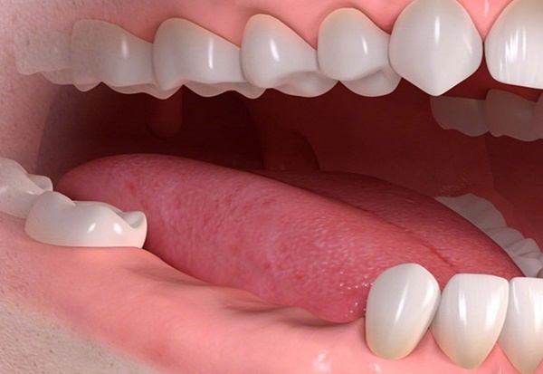 Thực tế không phải trường hợp nào cũng có thể trồng răng Implant All On 4