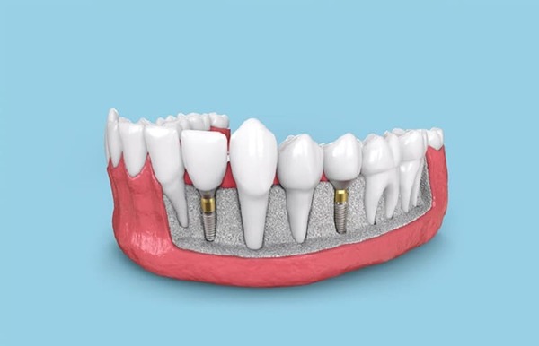 Răng Implant Tekka có tính thẩm mỹ cao