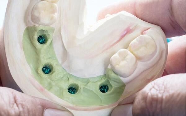 Hiện có 2 phương pháp lấy dấu răng Implant phổ biến