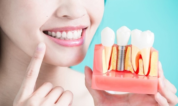 Phục hình răng sứ Implant sẽ đem đến cho bạn sự tự tin tuyệt đối